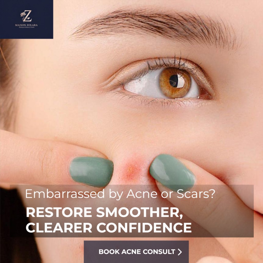 Embarrassed by acne or scars? Restore smoother, clearer confidence — Maison Zolara acne treatment Lansing MI