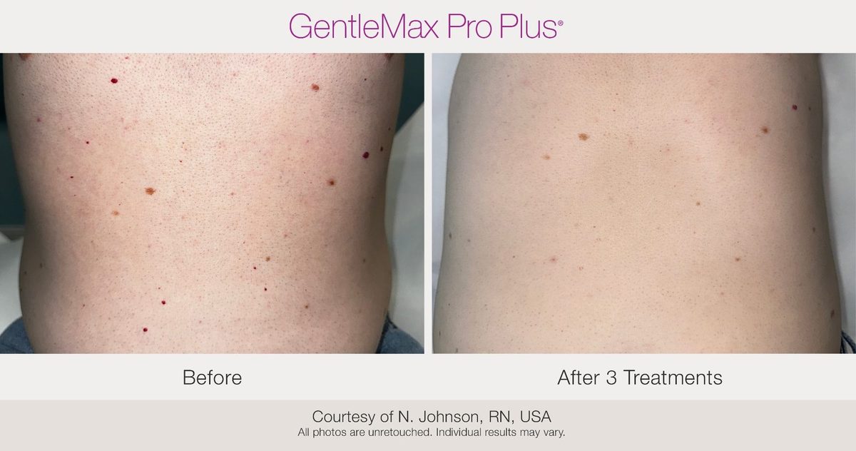 before and after cherry angiomas removal laser treatment Candela GentleMax Pro Plus after 3 sessions