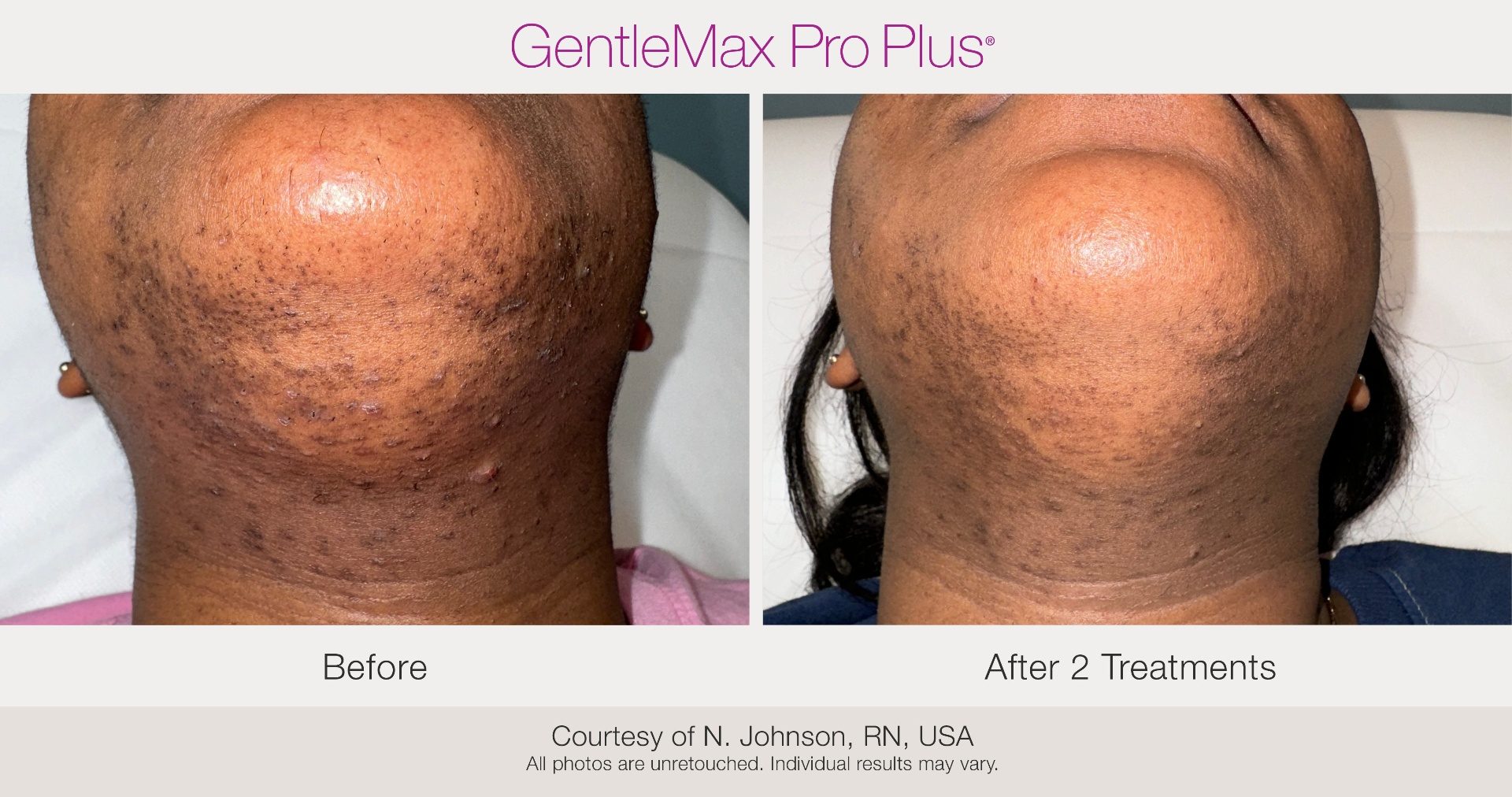 Upper lip and chin laser hair removal at Maison Zolara, Lansing MI