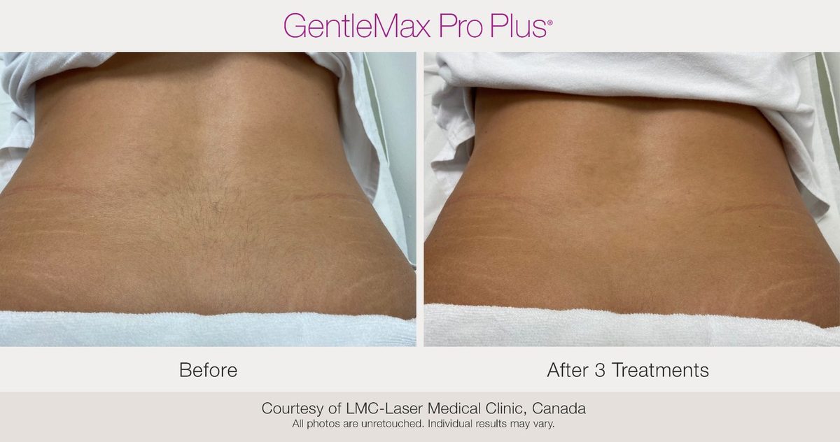 before and after laser hair removal lower back area after 3 sessions with Candela GentleMax Pro Lansing
