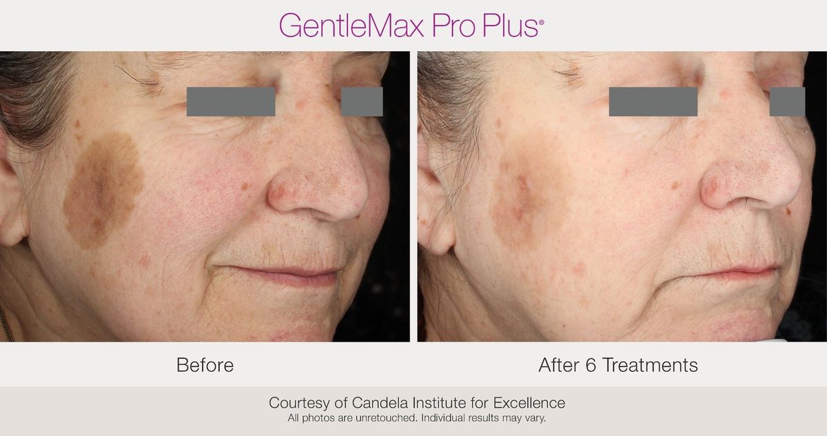 before and after facial pigmentation laser treatment Candela GentleMax Pro Plus after 6 sessions Lansing