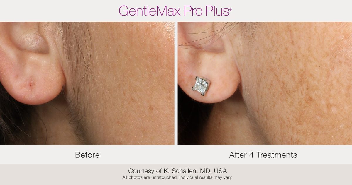 before and after earlobe skin tag removal laser treatment Candela GentleMax Pro Plus after 4 sessions