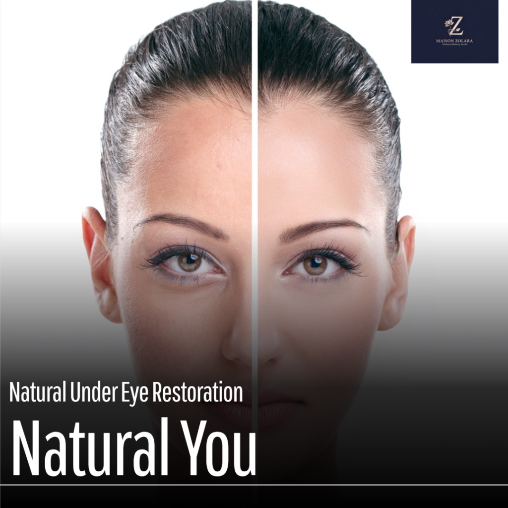 Natural under-eye restoration before and after — EZ Gel at Maison Zolara, Lansing MI