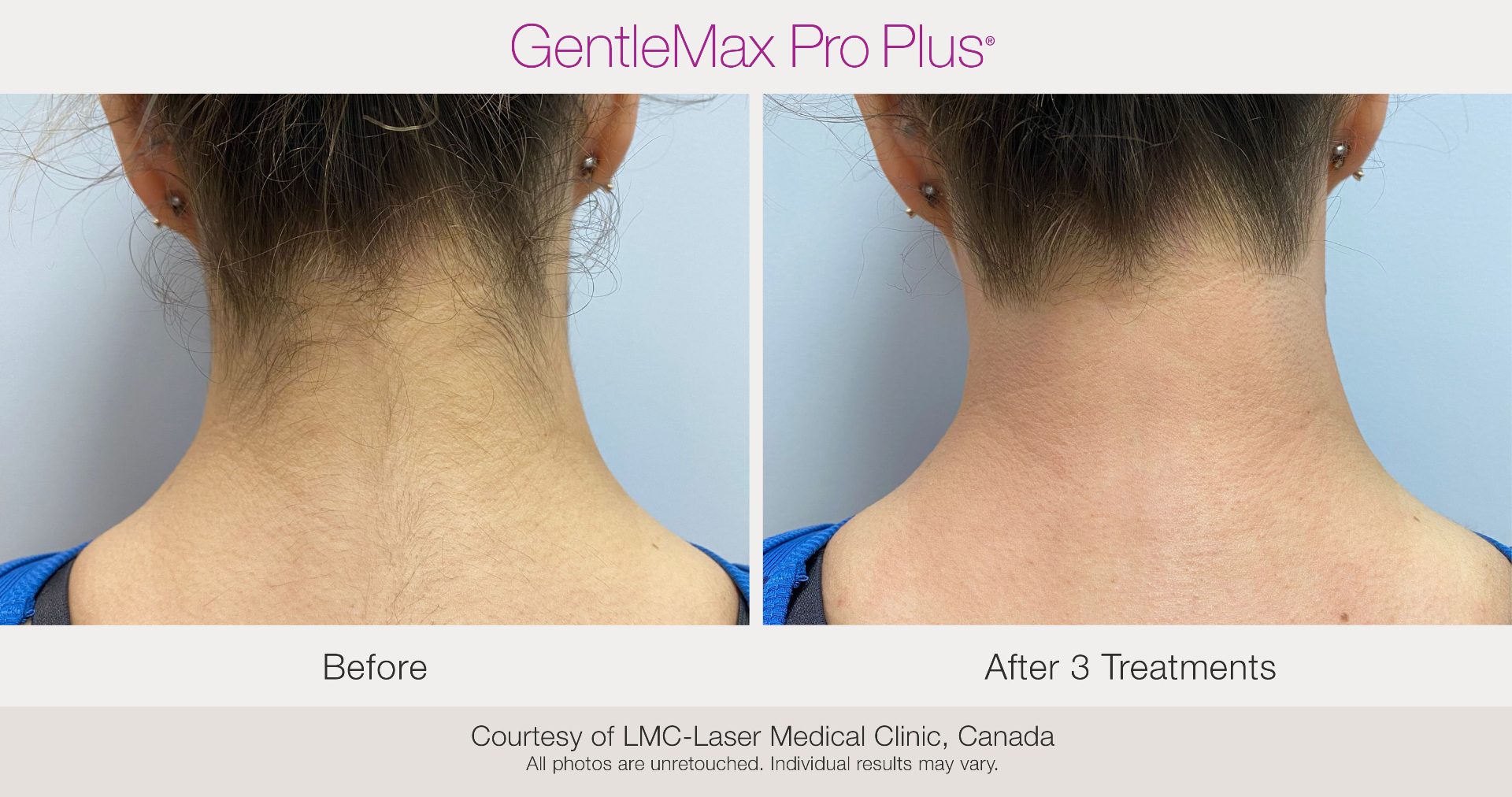 Before and after laser hair removal results on the nape of the neck
