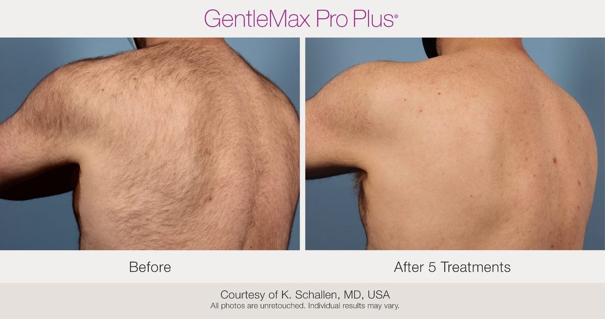 Laser hair removal results on Fitzpatrick V skin tone, neck area