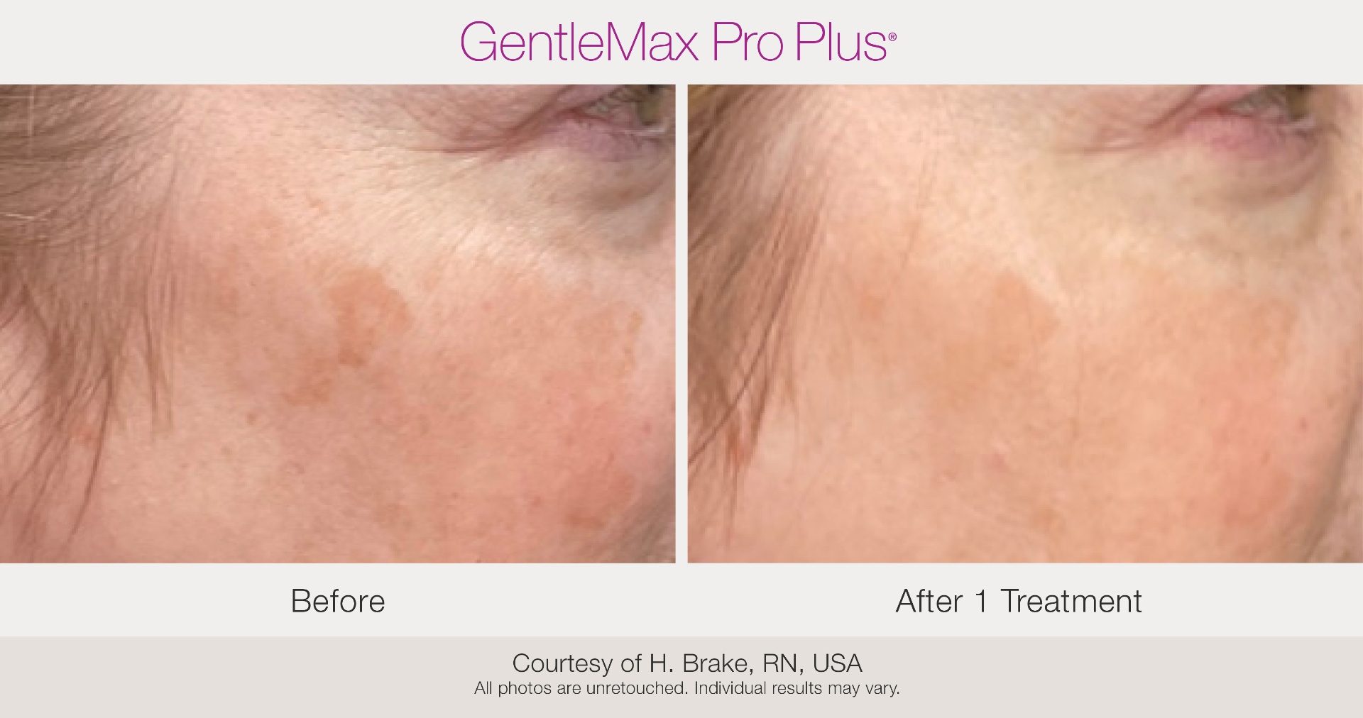 Before and after melasma treatment results on the cheek
